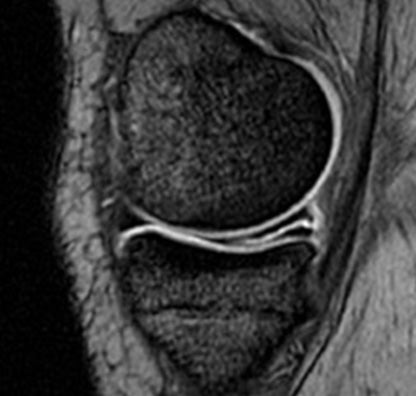 Meniscus Tear