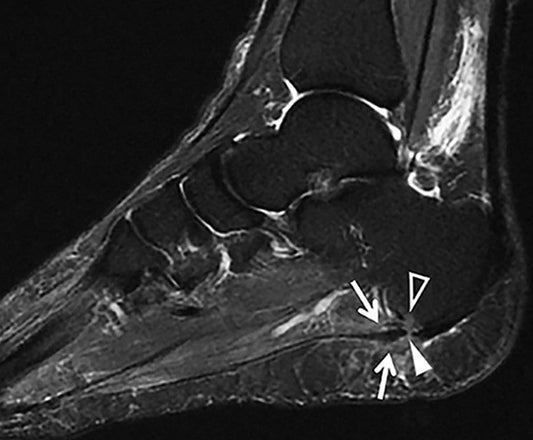 What is plantar fasciitis?